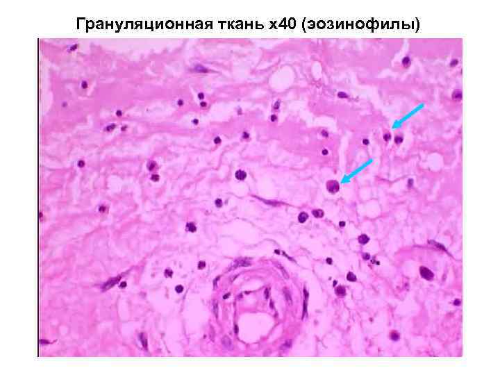 Грануляционная ткань х40 (эозинофилы) 