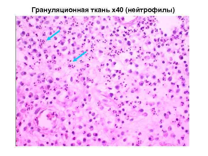 Грануляционная ткань х40 (нейтрофилы) 