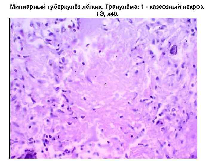 Милиарный туберкулёз лёгких. Гранулёма: 1 - казеозный некроз. ГЭ, х40. 
