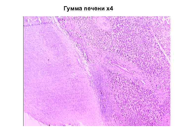 Солитарная гумма печени микропрепарат рисунок