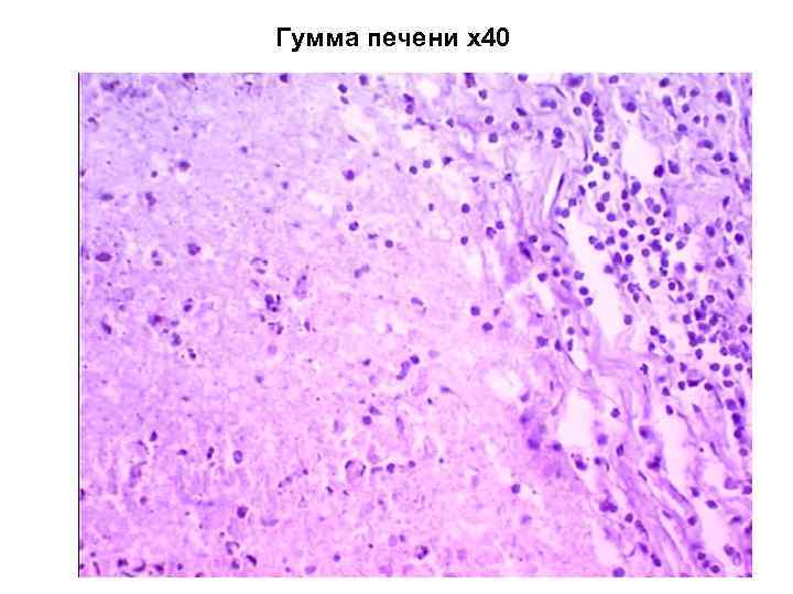 Гумма печени х40 