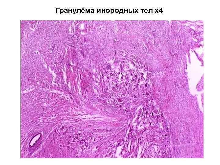 Гранулёма инородных тел х4 