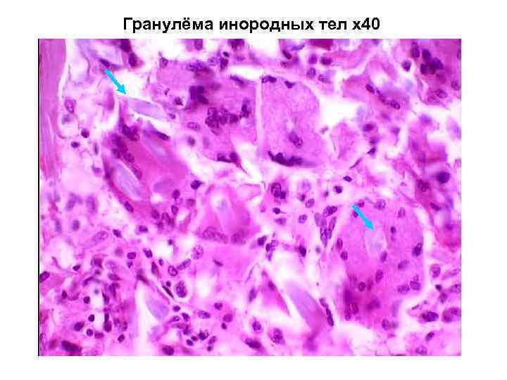 Гранулёма инородных тел х40 