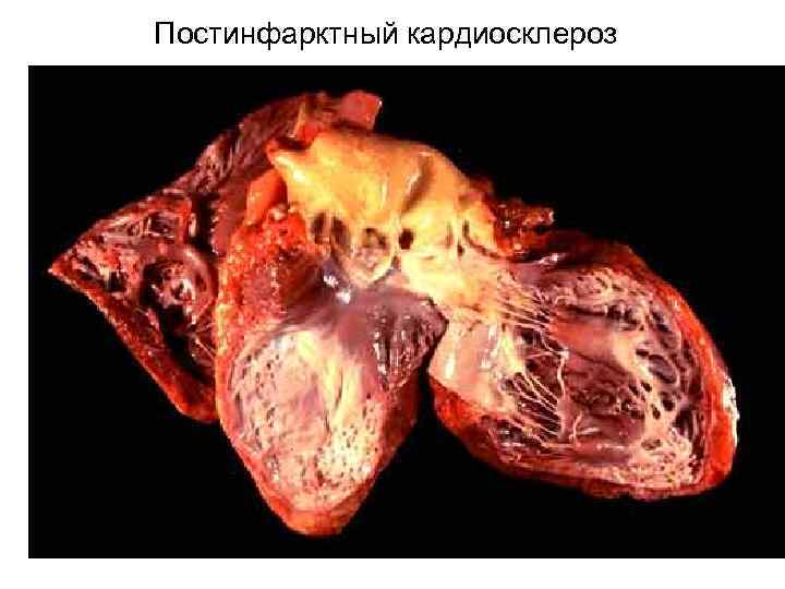 Постинфарктный кардиосклероз 