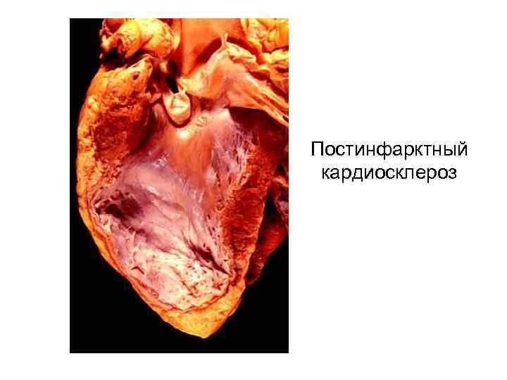 Постинфарктный кардиосклероз 