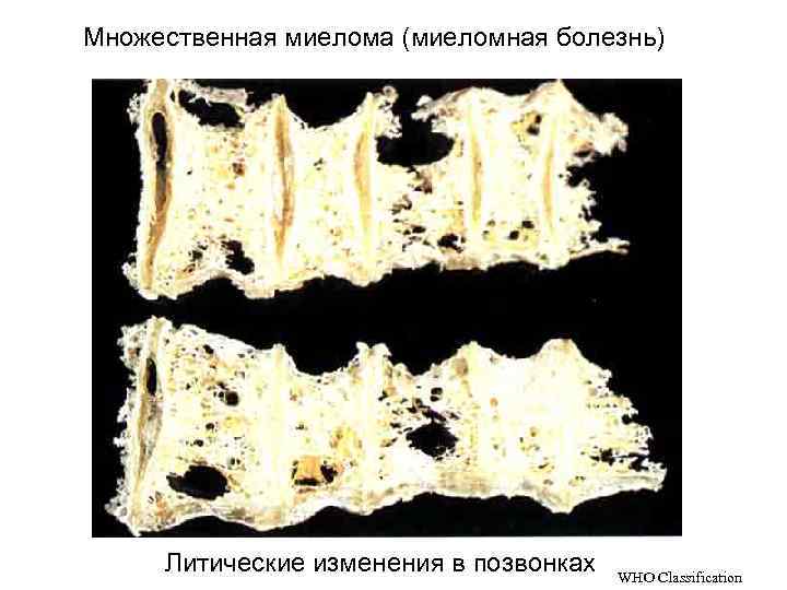 Множественная миелома (миеломная болезнь) Литические изменения в позвонках WHO Classification 