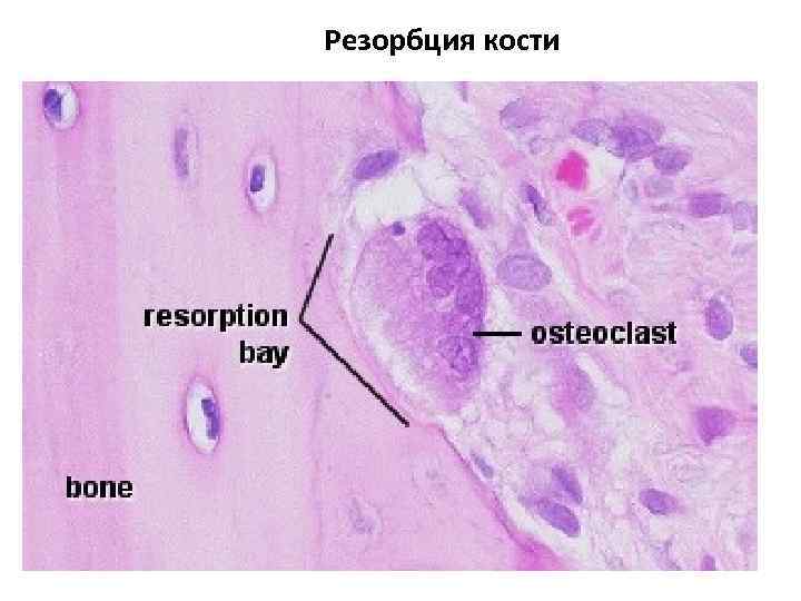 Резорбция кости 