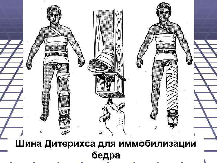 Шина Дитерихса для иммобилизации бедра 