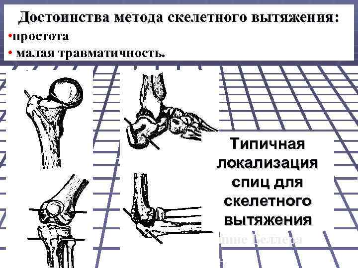 Достоинства метода скелетного вытяжения: • простота • малая травматичность. Типичная локализация Скелетное спиц для