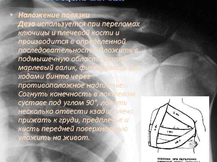 Наложение повязки Дезо алгоритм. Наложение повязки на подмышечную область. Повязка Дезо на грудную клетку. Дезо повязка характеристика.