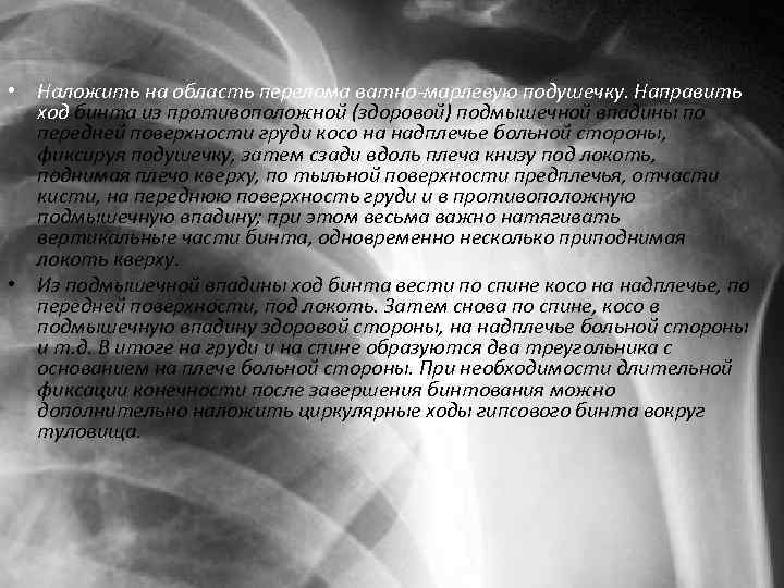  • Наложить на область перелома ватно-марлевую подушечку. Направить ход бинта из противоположной (здоровой)