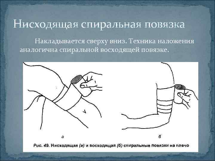 Спиральная с перегибами. Показания для наложения спиральной повязки с перегибами. Технология наложения спиральной повязки. Методика наложения спиралевидной повязки.. Спиральная бинтовая повязка.