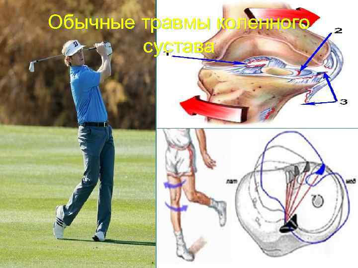 Обычные травмы коленного сустава 