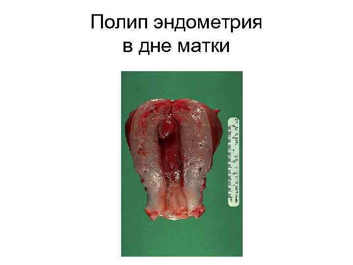Полип эндометрия в дне матки 