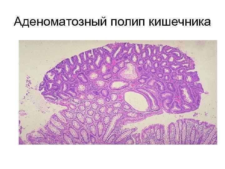 Аденоматозный полип кишечника 