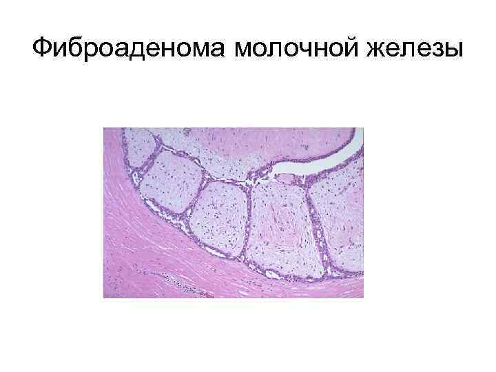 Фиброаденоматоз молочной. Интраканаликулярная фиброаденома молочной железы микропрепарат. Интраканаликулярная фиброаденома молочной железы гистология. Периканаликулярная фиброаденома молочной железы микропрепарат. Периканаликулярная фиброаденома мж Патан микропрепарат.