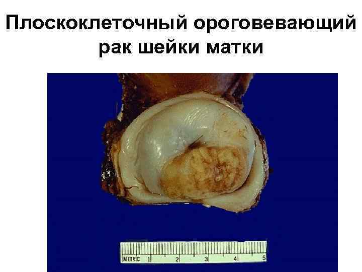 Плоскоклеточный ороговевающий рак шейки матки 