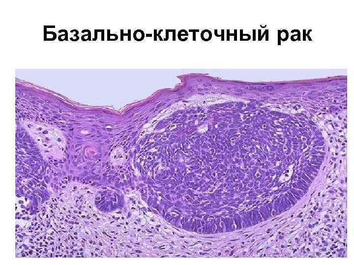 Базально-клеточный рак 