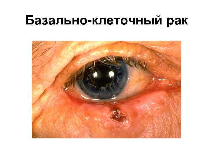 Базально-клеточный рак 