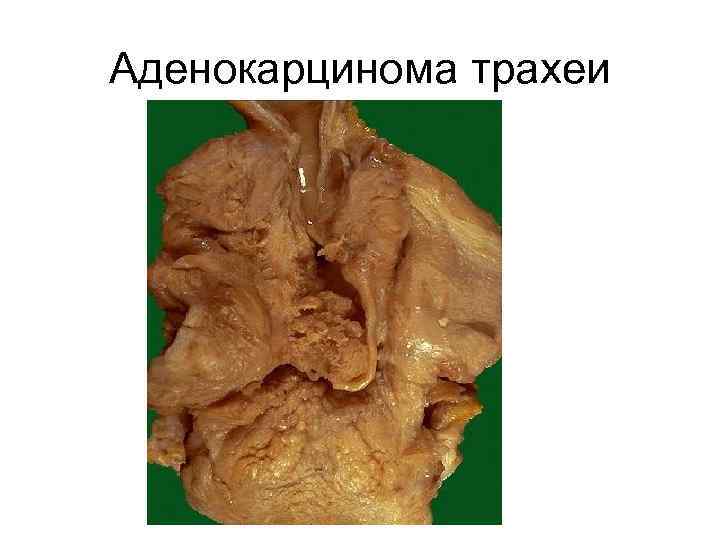 Аденокарцинома трахеи 
