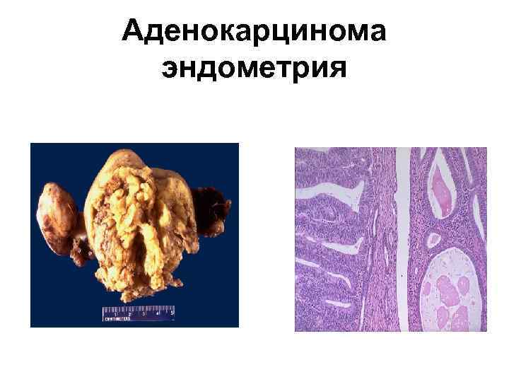 Аденокарцинома эндометрия 