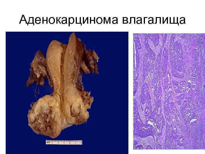 Аденокарцинома влагалища 