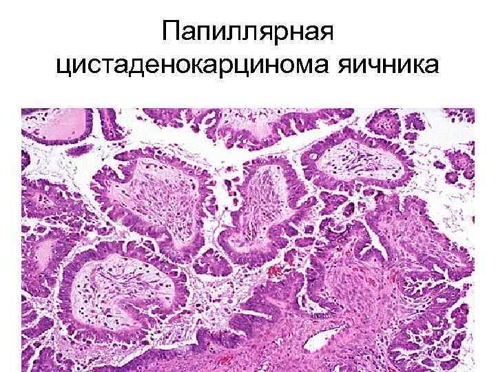 Папиллярная цистаденокарцинома яичника 
