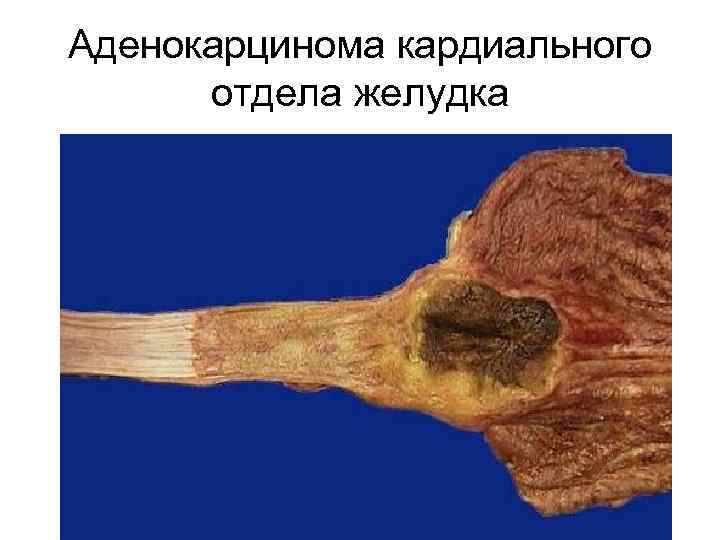 Аденокарцинома кардиального отдела желудка 