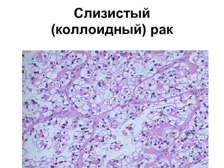 Слизистый (коллоидный) рак 