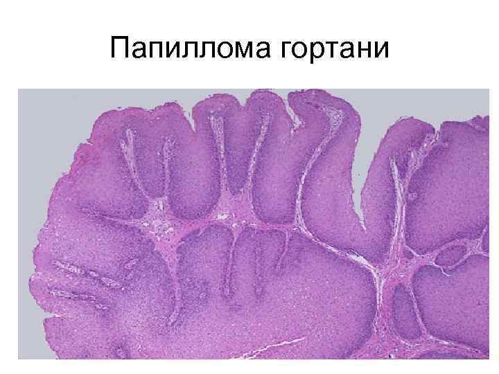 Папиллома гортани 