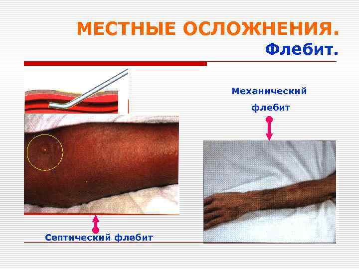 МЕСТНЫЕ ОСЛОЖНЕНИЯ. Флебит. Механический флебит Септический флебит 