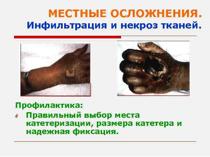 МЕСТНЫЕ ОСЛОЖНЕНИЯ. Инфильтрация и некроз тканей. Профилактика: G Правильный выбор места катетеризации, размера катетера