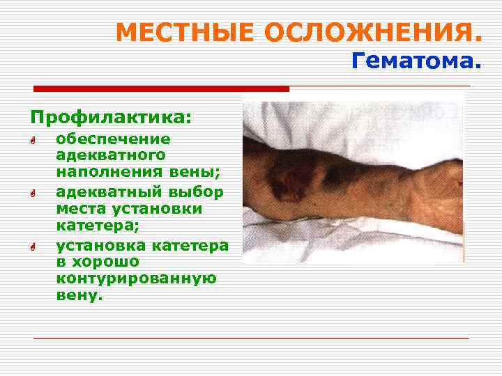 МЕСТНЫЕ ОСЛОЖНЕНИЯ. Гематома. Профилактика: G G G обеспечение адекватного наполнения вены; адекватный выбор места