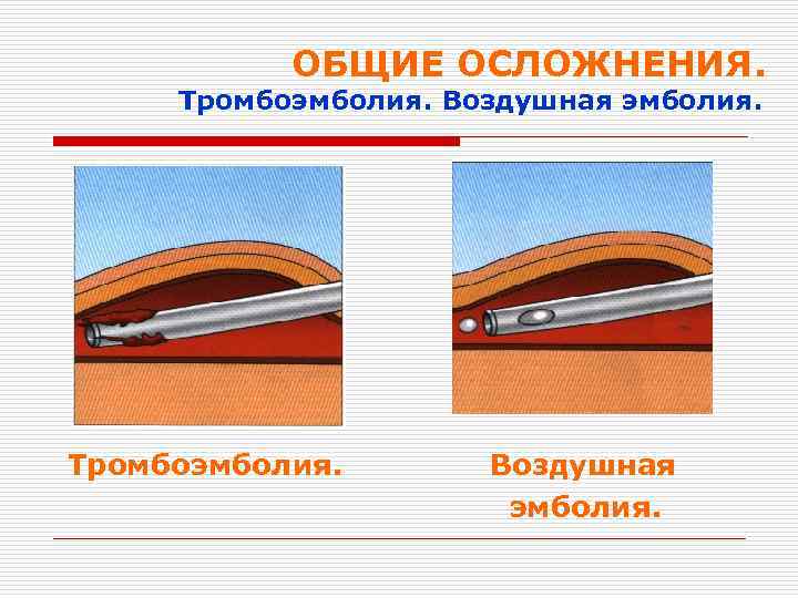 ОБЩИЕ ОСЛОЖНЕНИЯ. Тромбоэмболия. Воздушная эмболия. Тромбоэмболия. Воздушная эмболия. 