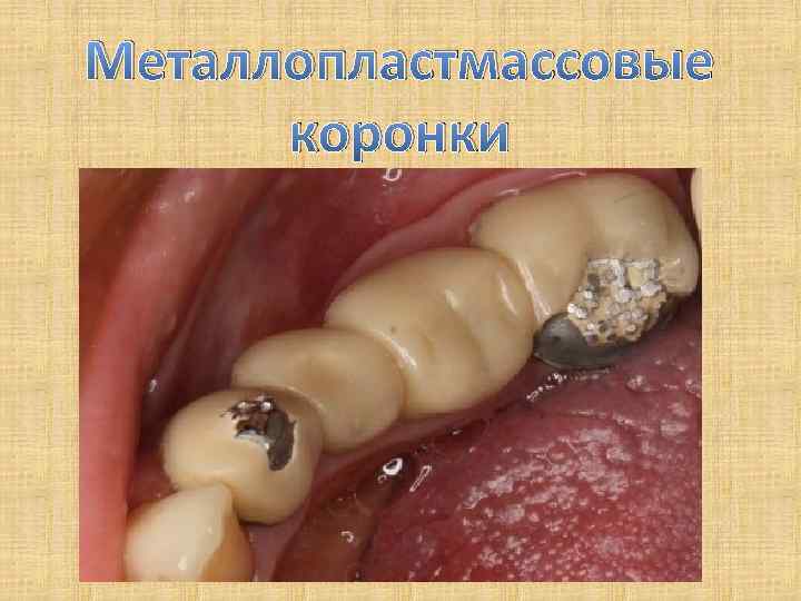 Металлопластмассовые коронки 