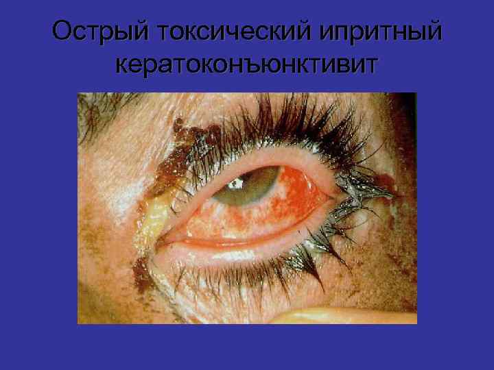 Острый токсический ипритный кератоконъюнктивит 