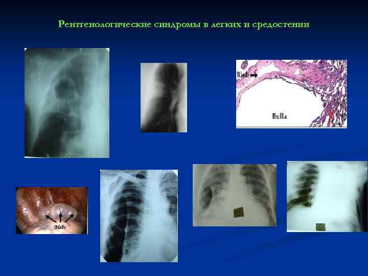 Рентгенологические синдромы в легких и средостении 