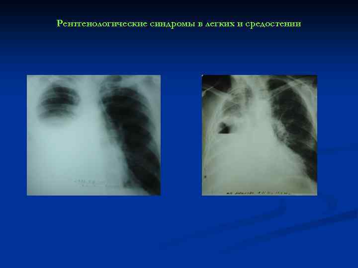 Рентгенологические синдромы в легких и средостении 