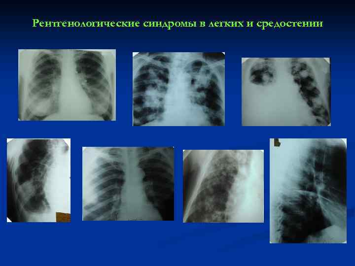 Рентгенологические синдромы в легких и средостении 