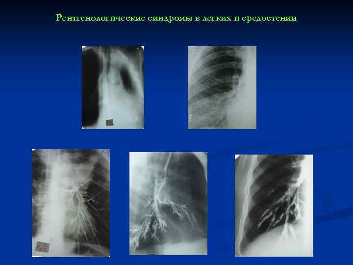Рентгенологические синдромы в легких и средостении 