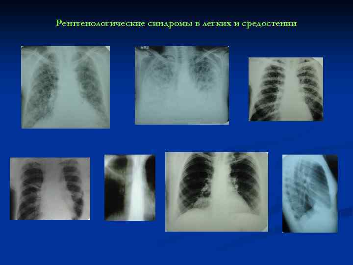 Рентгенологические синдромы в легких и средостении 