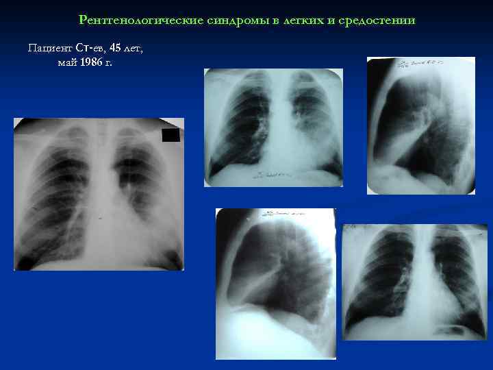 Рентгенологические синдромы в легких и средостении Пациент Ст-ев, 45 лет, май 1986 г. 
