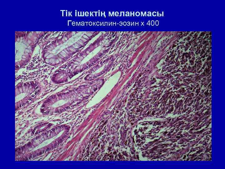 Тік ішектің меланомасы Гематоксилин-эозин х 400 