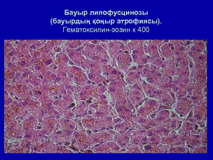 Бауыр липофусцинозы (бауырдың қоңыр атрофиясы). Гематоксилин-эозин х 400 