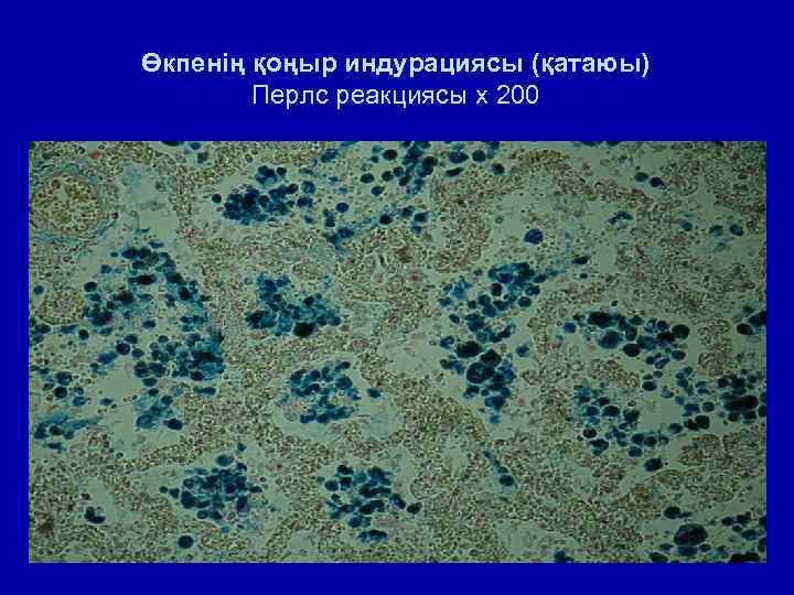 Өкпенің қоңыр индурациясы (қатаюы) Перлс реакциясы х 200 
