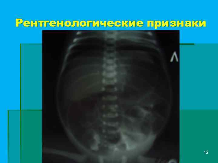 Рентгенологические признаки 12 