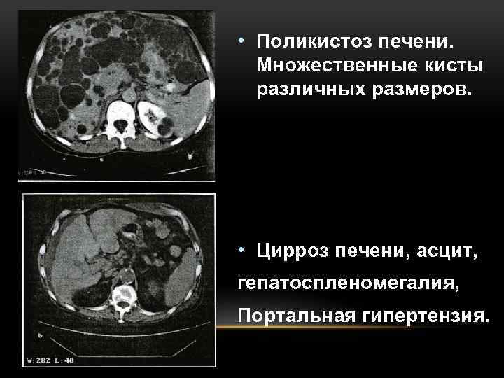  • Поликистоз печени. Множественные кисты различных размеров. • Цирроз печени, асцит, гепатоспленомегалия, Портальная
