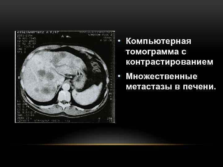 Контраст печени. Кт метастазы печени контрастирование. Кистозные метастазы в печени на кт. Метастазы в печени на кт с контрастом.