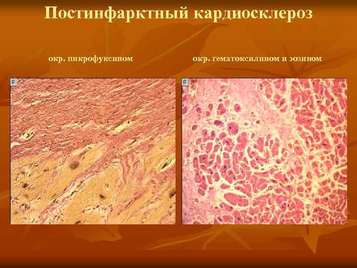Постинфарктный кардиосклероз окр. пикрофуксином окр. гематоксилином и эозином 