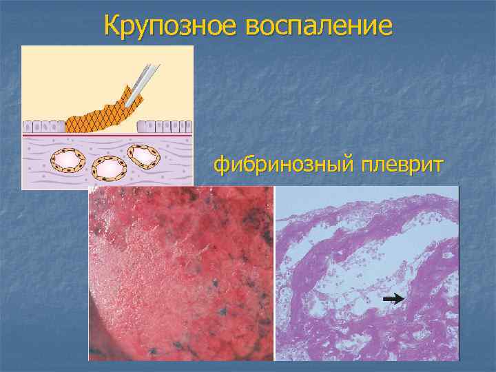 Крупозное воспаление фибринозный плеврит 